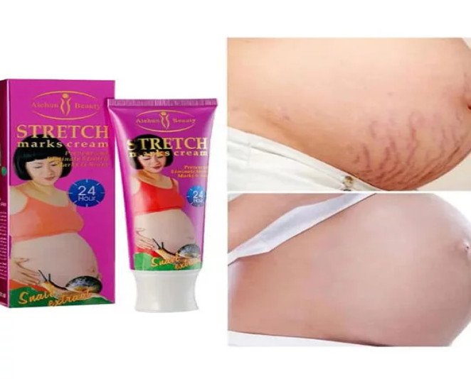 Stretch Marks Cream